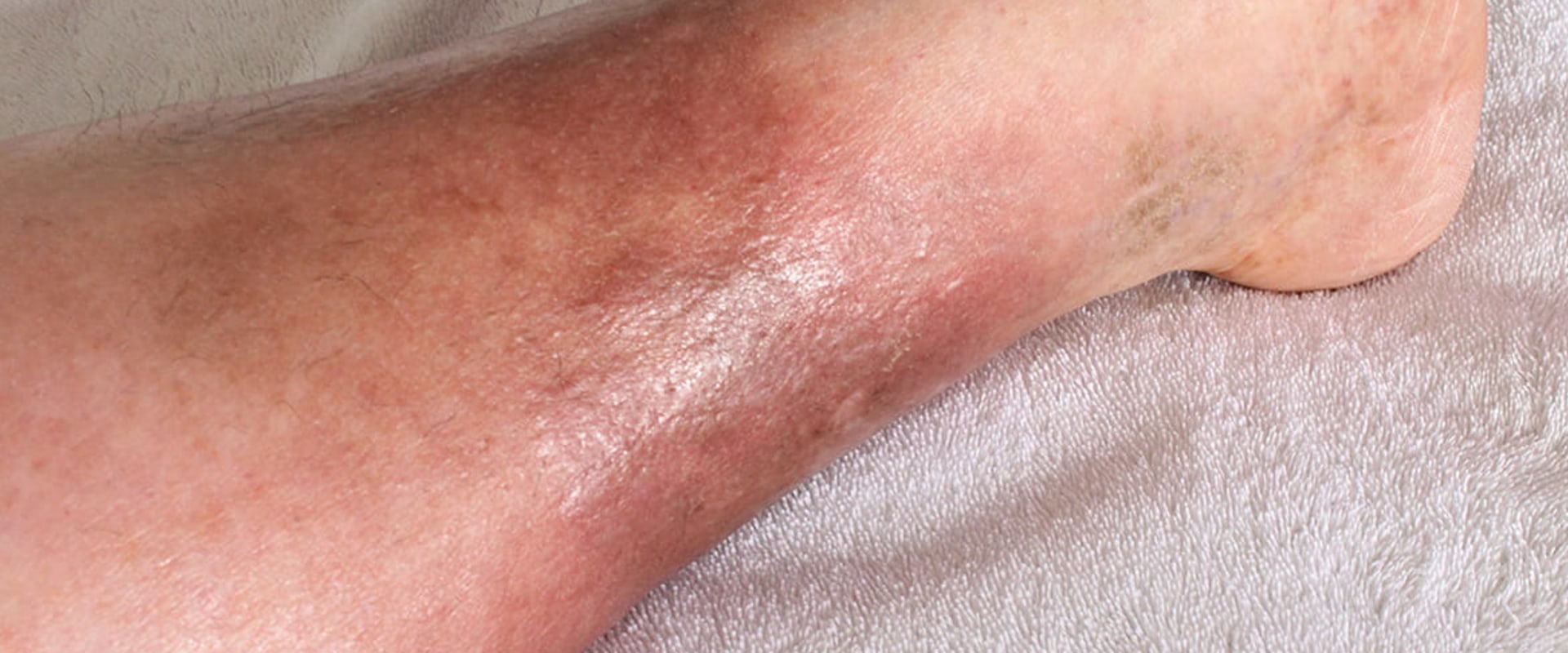 How Early Wound Assessment Improves Cellulitis Diagnosis Of The Lower Limb Outcomes