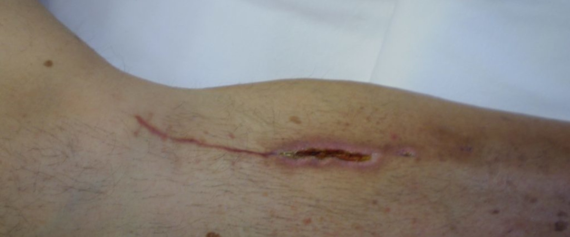 Assessment Techniques For Different Types Of Skin Tunneling Wounds