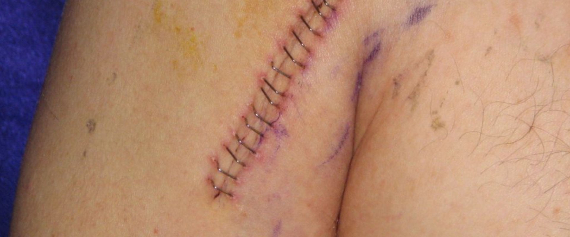 The Essential Stages Of Surgical Incision Wound Healing And Assessment