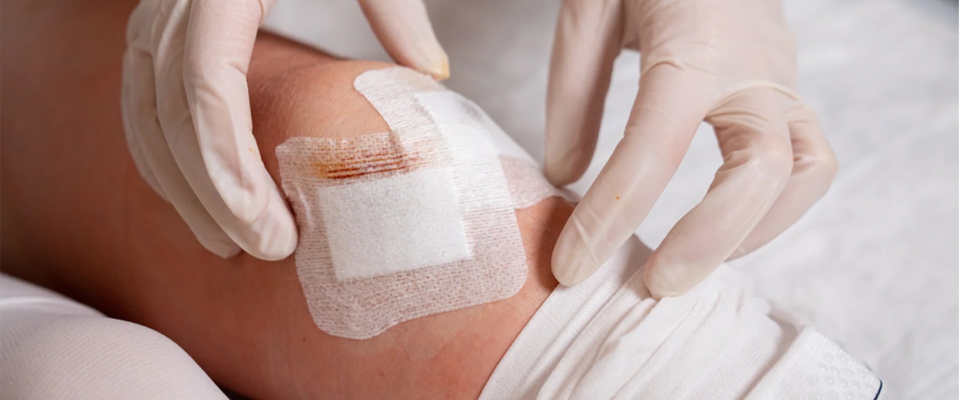 Achieving Better Outcomes in Surgical Site Infection Wound Treatment With Precise Assessments