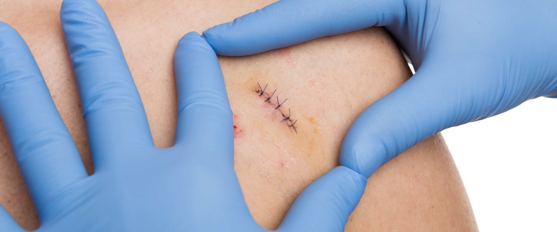 When Do Dissolvable Stitches Disappear? How Long They Last and the Role of Wound Assessment