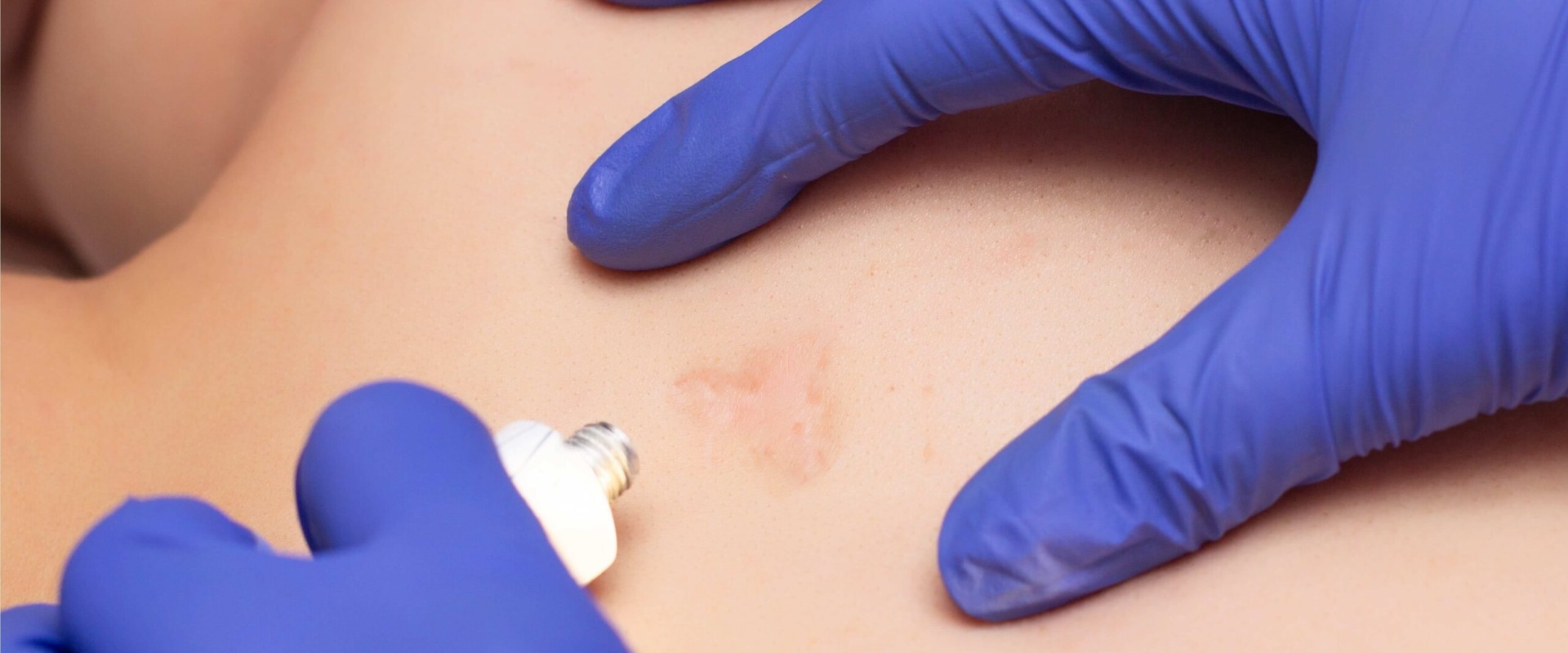 Achieving Better Scar Management With The Help Of Professional Wound Assessment