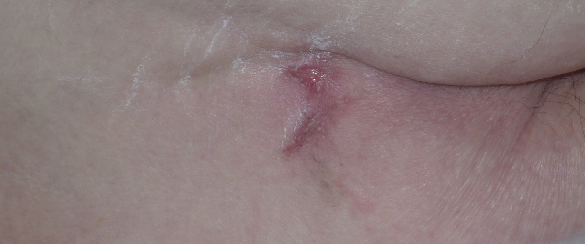 Why The Best Barrier Cream For Bed Sores Is Vital in Emergency Wound Services