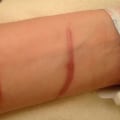 How to Identify and Manage Hypertrophic Scar Healing Stages During Wound Care