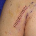 The Essential Stages Of Surgical Incision Wound Healing And Assessment
