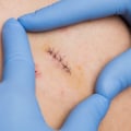 When Do Dissolvable Stitches Disappear? How Long They Last and the Role of Wound Assessment