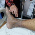 Getting The Right Care For Arterial Insufficiency Leg Ulcers With Wound Assessment Services