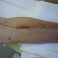 The Importance of Proper Wound Documentation