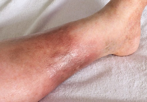 How Early Wound Assessment Improves Cellulitis Diagnosis Of The Lower Limb Outcomes