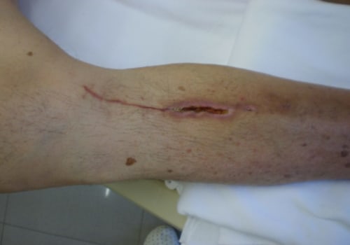 Assessment Techniques For Different Types Of Skin Tunneling Wounds