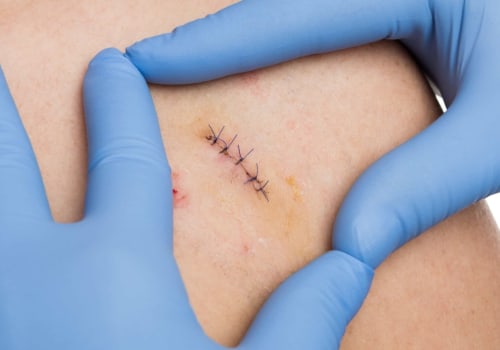 When Do Dissolvable Stitches Disappear? How Long They Last and the Role of Wound Assessment