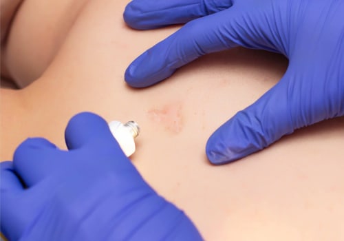 Achieving Better Scar Management With The Help Of Professional Wound Assessment