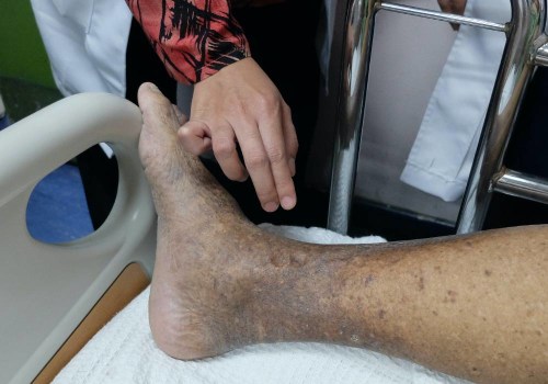 Getting The Right Care For Arterial Insufficiency Leg Ulcers With Wound Assessment Services