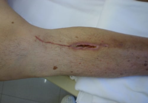 The Importance of Proper Wound Documentation